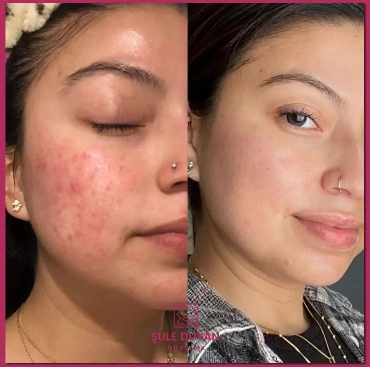 Microneedling eksozom tedavisi ile sivilce izi ve gözenek bakımı